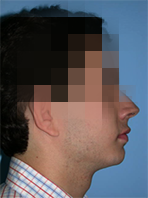 implantes dentales